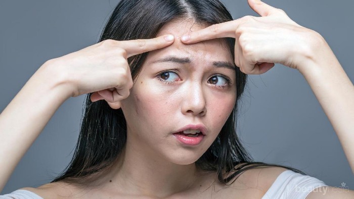 Hati-hati! 5 Bahan Makeup Ini Berpotensi Memunculkan Jerawat