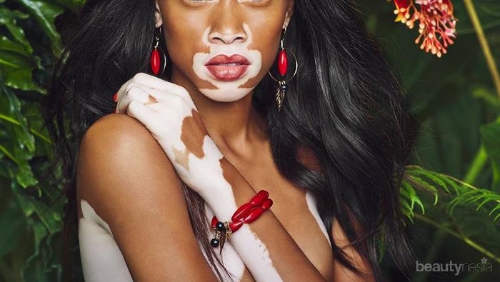 So Inspiring! 4 Model Terkenal Pemilik Kulit Unik nan Seksi Ini Tampil Percaya Diri