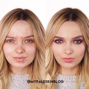Tips Make Up Natural Super Flawless untuk Wajah dengan Kulit Berjerawat