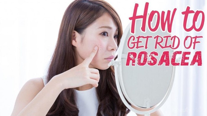 Perawatan Alami untuk Mengatasi Bintik Kemerahan Pada Wajah (Rosacea)