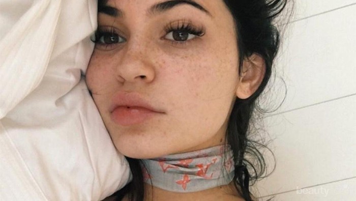 Inilah Penyebab Flek Hitam dan Begini Cara Tepat dan Simpel Mengatasinya!