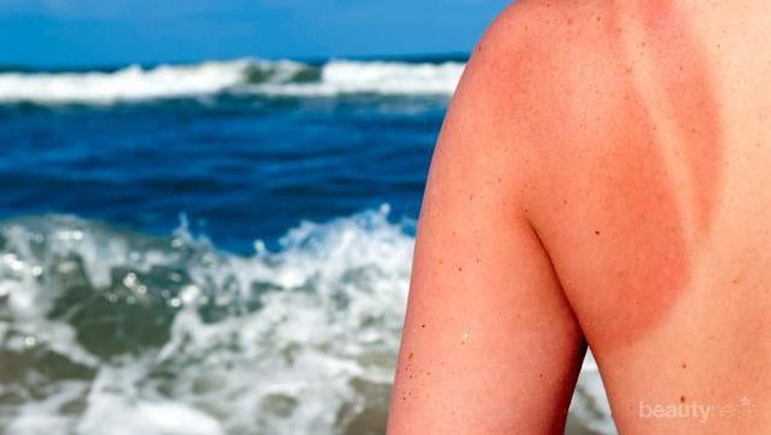 Kulit Belang Karena Sinar Matahari? Coba Atasi dengan 4 Cara Mudah Ini!