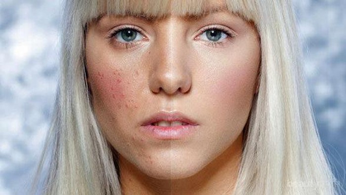 Eits, Bahan-Bahan Skincare Ini Wajib Kamu Hindari Jika Kulitmu Berjerawat! Eits, Bahan-Bahan Skincare Ini Wajib Kamu Hindari Jika Kulitmu Berjerawat!