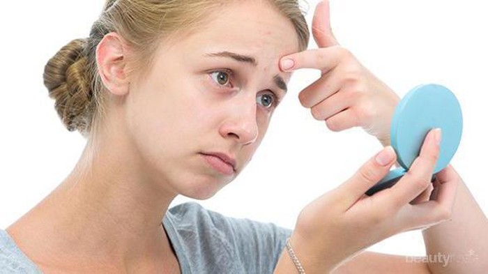 Eits, Ketahui Dulu Macam-Macam Jerawat Agar Kamu Tahu Cara Tepat Mengatasinya!
