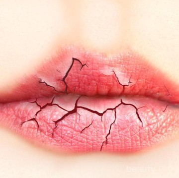 5 Tips Mengatasi Bibir Kering Saat Puasa yang Mudah dan Jitu