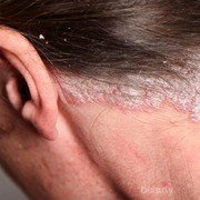 Jenis-jenis Psoriasis, Penyakit Kulit Menahun yang Tidak Menular dan Cara Mengatasinya!