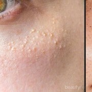 Jangan Salah, Ini Dia Perbedaan Komedo Hitam dan Komedo Putih