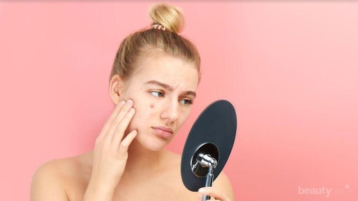 Duh, Jerawat Ternyata Bisa Muncul dari Hal Sepele Ini