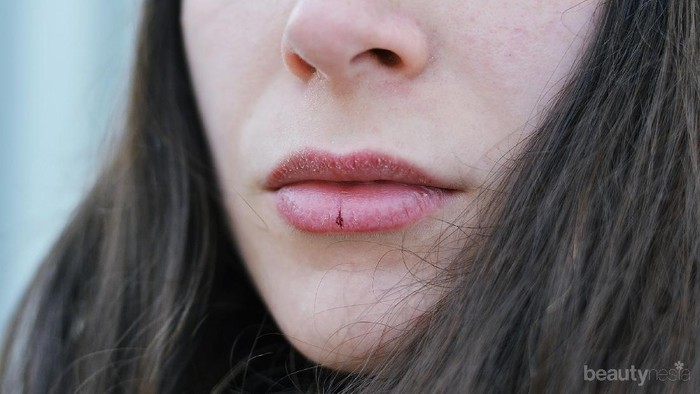 Tampil Lebih Menawan, Ini 5 Bahan Alami yang Efektif Rawat Bibir Kering