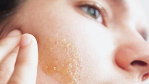 Ketahui Cara Mengatasi Jerawat dengan Tahapan Skincare yang Tepat