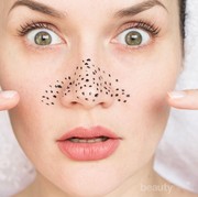 Simak yuk Kekurangan dan Kelebihan 4 Cara Menghilangkan Komedo Ini!