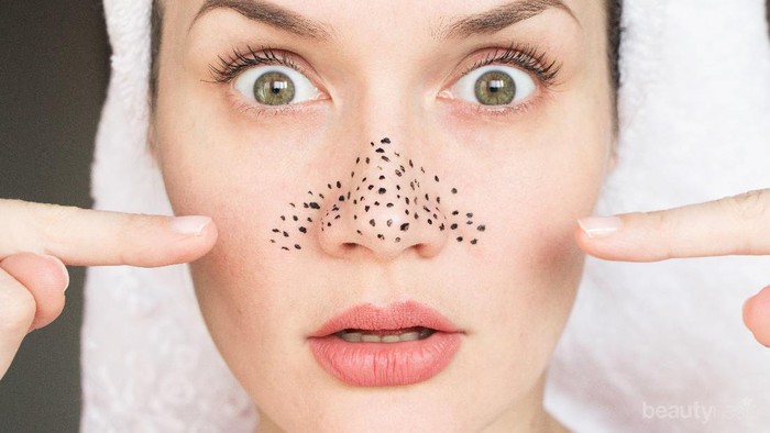 Simak yuk Kekurangan dan Kelebihan 4 Cara Menghilangkan Komedo Ini!