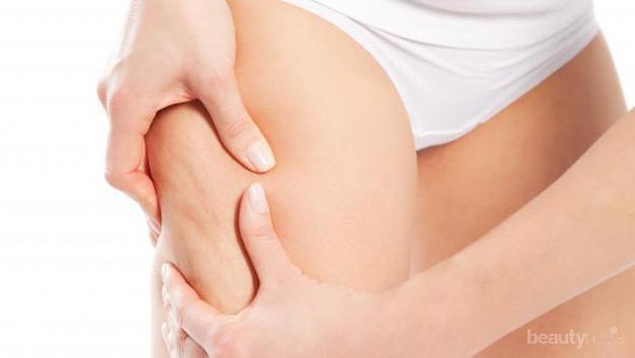 Yuk, Tahu Lebih Lanjut Soal Stretch Mark dan Cara Menghilangkannya!