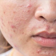 Agar Tidak Salah Penanganan, Pahami Perbedaan Jenis-Jenis Jerawat Ini