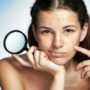 Jerawat Batu Muncul di Jidat? Segera Atasi dengan Cara Alami Ini, Bahannya Mudah Didapat!