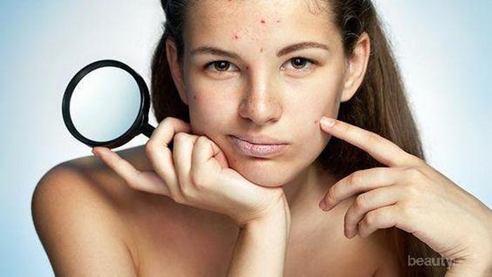 Jerawat Batu Muncul di Jidat? Segera Atasi dengan Cara Alami Ini, Bahannya Mudah Didapat!