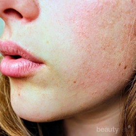 Habis Liburan ke Pantai, Ini Cara Alami Mengatasi Sunburn