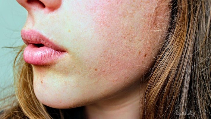 Habis Liburan ke Pantai, Ini Cara Alami Mengatasi Sunburn