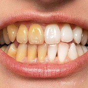 Gigi Menguning? Yuk Atasi dengan 4 Bahan Alami Ini!
