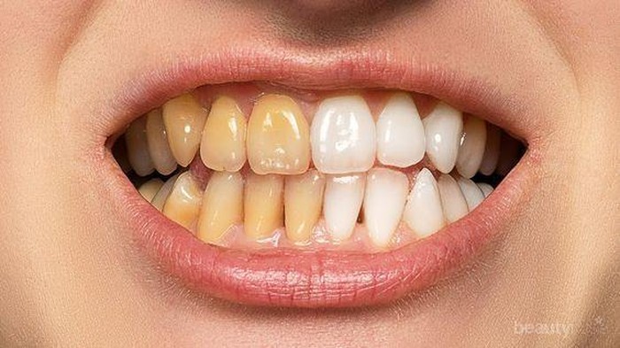 Gigi Menguning? Yuk Atasi dengan 4 Bahan Alami Ini!