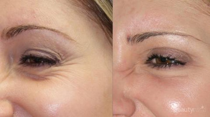 5 Langkah Hilangkan Kerutan di Wajah, Caranya Gampang!