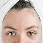 Jangan Sampai Salah Paham! Berikut Perbedaan Purging dan Break Out