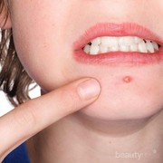 Hati-Hati! Ini Dia Letak Jerawat yang Tidak Boleh Dipencet