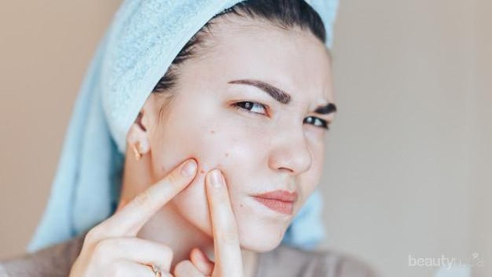 Enggak Melulu Pakai Skincare, Kamu Bisa Atasi Jerawat dengan Cara Ini!