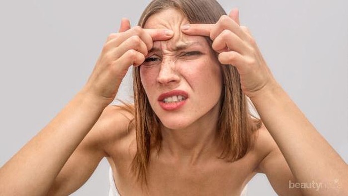 Ternyata Ini Penyebab dan Solusi untuk Jerawat Berdasarkan Letaknya di Wajah!