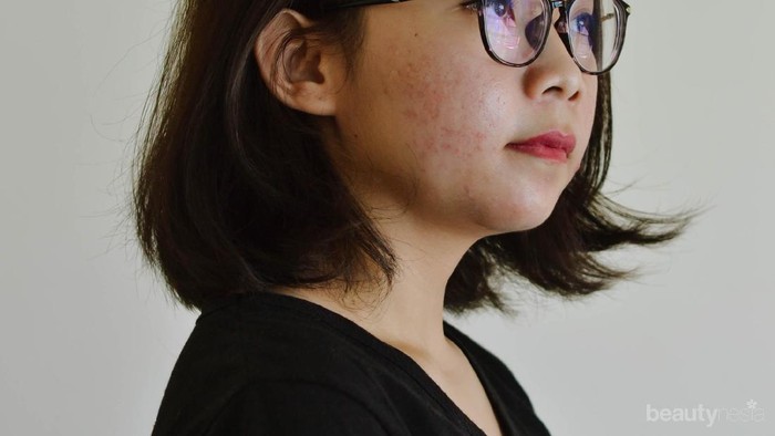 4 Bahan Skincare Ini Wajib Kamu Jauhi Saat Kulit Berjerawat