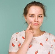 Duh, Jerawat Tiba-tiba Muncul! Lakukan Hal Ini untuk Pertolongan Pertama agar Jerawat Cepat Kempes