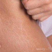 [FORUM] Gimana cara menghilangkan atau memudarkan Stretchmarks putih ya?
