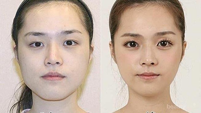 Ingin Menambah Lipatan Mata? Ketahui Dulu Serba-serbi Operasi Kelopak Mata Berikut!