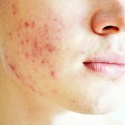 Kenali Cara Mengatasi Bekas Jerawat Sesuai Jenisnya!