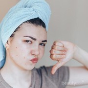 Bekas Jerawat Susah Hilang? Gak Perlu Khawatir Lagi, Lakukan 8 Perawatan Ini Sekarang!