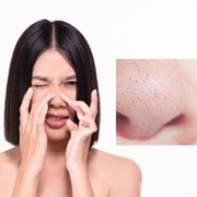 Jangan Salah Lagi Ya, Ternyata ini Bedanya Sebaceous Filaments dengan Blackheads!