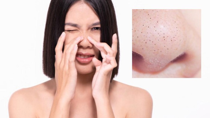 Jangan Salah Lagi Ya, Ternyata ini Bedanya Sebaceous Filaments dengan Blackheads!