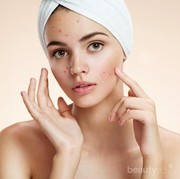 Yuk, Rutin Lakukan 5 Tips Ini untuk Dapatkan Kulit Sehat dan Bebas Jerawat!