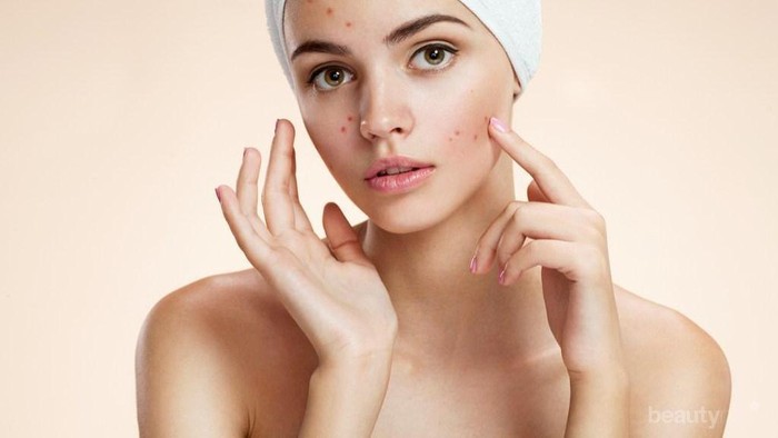 Yuk, Rutin Lakukan 5 Tips Ini untuk Dapatkan Kulit Sehat dan Bebas Jerawat!