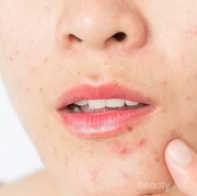 [FORUM] Rekomendasi BB Cream untuk Kulit Berminyak dan Berjerawat Dong..