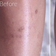 [FORUM]  Bekas luka alergi di lengan, bisa hilang gak ya?