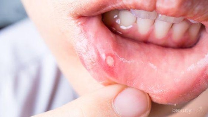 Deretan Makanan yang Ampuh Obati Sariawan