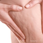 Sebal dengan Selulit yang Mengganggu? Cara Alami Ini Bisa Jadi Solusi!
