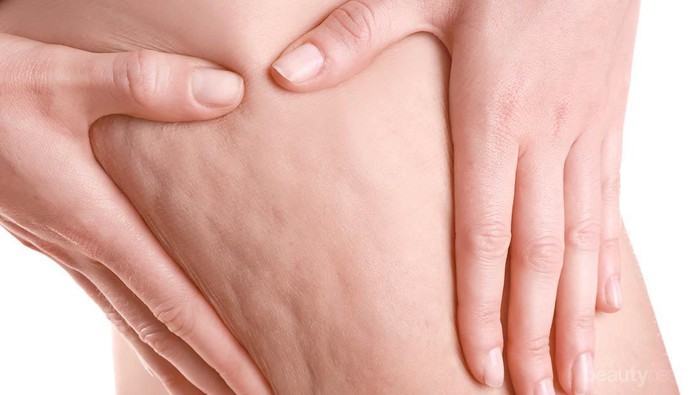 Sebal dengan Selulit yang Mengganggu? Cara Alami Ini Bisa Jadi Solusi!