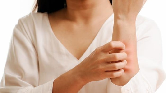 Inilah yang Perlu Kamu Ketahui tentang Urtikaria!