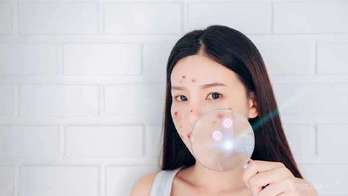 Jerawat Batu Ngeganggu? Ternyata Ini Lho Penyebabnya