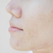 Gatal dan Ruam di Wajah Bikin Ganggu? Ini Solusinya!