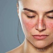 Penting! Ini Ciri-ciri dan Penyebab Penyakit Lupus pada Wanita