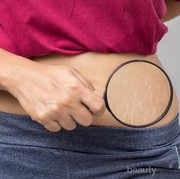 Atasi Stretch Mark dengan Manfaatkan Bahan Alami Ini