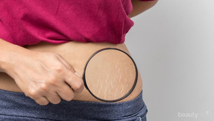 Atasi Stretch Mark dengan Manfaatkan Bahan Alami Ini
